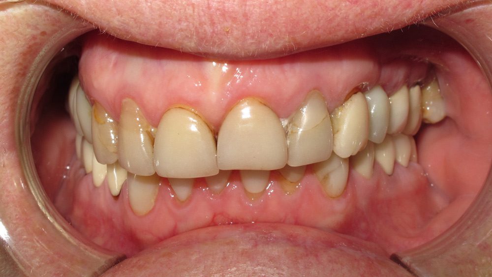 dental crown before