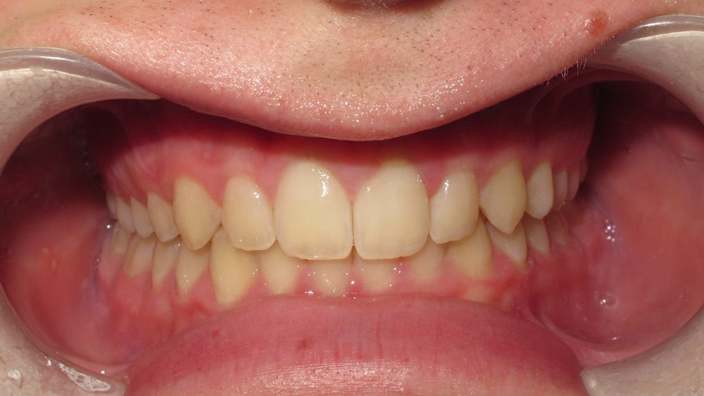 Teen Invisalign after