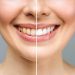 Teeth whitening comparison